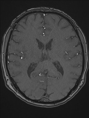 Cerebral arteriovenous malformation (Radiopaedia 84015-99245 Axial TOF 140).jpg