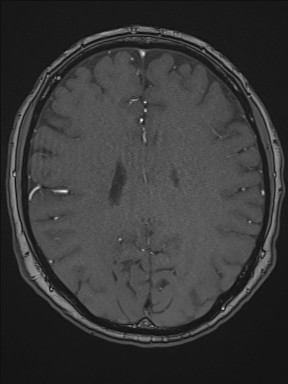 File:Cerebral arteriovenous malformation (Radiopaedia 84015-99245 Axial TOF 152).jpg
