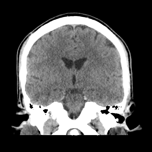 File:Cerebral arteriovenous malformation (Spetzler-Martin grade 2) (Radiopaedia 41262-44076 Coronal non-contrast 31).png