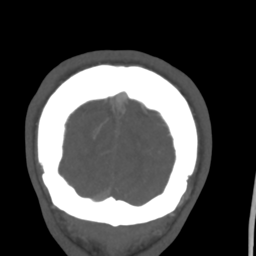 File:Cerebral arteriovenous malformation (Spetzler-Martin grade 2) (Radiopaedia 41262-44076 F 61).png