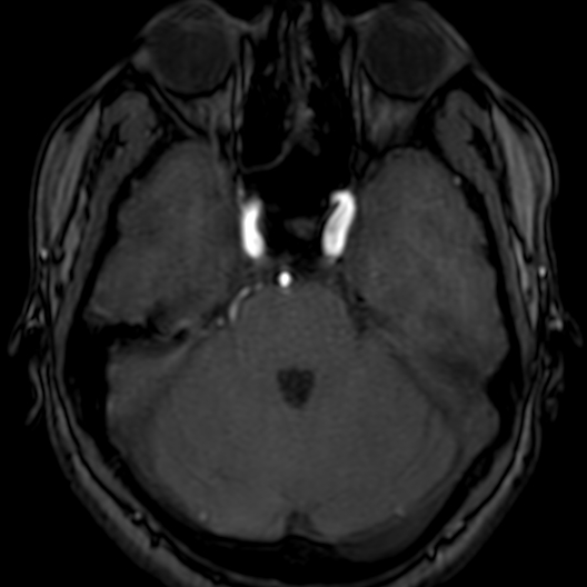 Cerebral arteriovenous malformation at posterior body of corpus callosum (Radiopaedia 74111-84925 Axial MRA 57).jpg