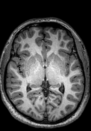 Cerebral arteriovenous malformation at posterior body of corpus callosum (Radiopaedia 74111-84925 Axial T1 152).jpg