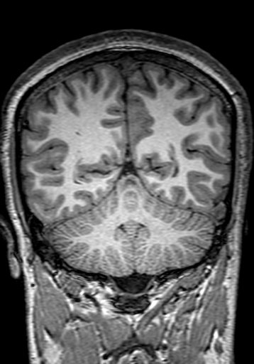Cerebral arteriovenous malformation at posterior body of corpus callosum (Radiopaedia 74111-84925 Coronal T1 249).jpg