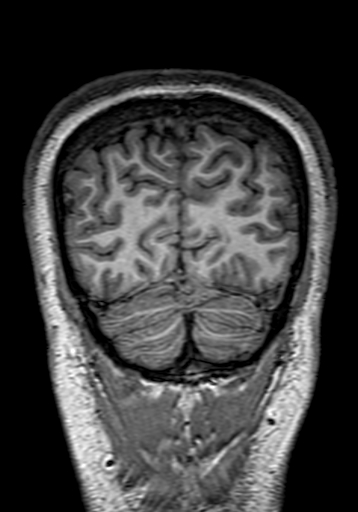Cerebral arteriovenous malformation at posterior body of corpus callosum (Radiopaedia 74111-84925 Coronal T1 306).jpg