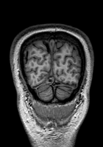 File:Cerebral arteriovenous malformation at posterior body of corpus callosum (Radiopaedia 74111-84925 Coronal T1 322).jpg