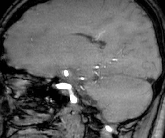 Cerebral arteriovenous malformation at posterior body of corpus callosum (Radiopaedia 74111-84925 J 150).jpg