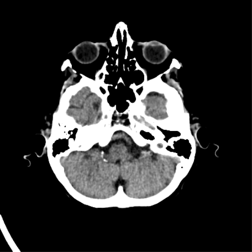 File:Cerebral arteriovenous malformation with lobar hemorrhage (Radiopaedia 44725-48510 Axial non-contrast 12).png