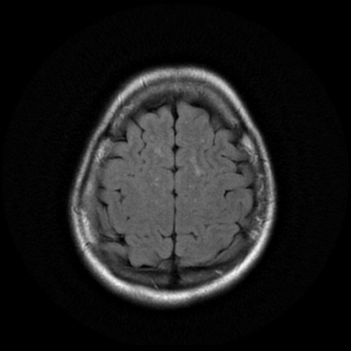 File:Cerebral autosomal dominant arteriopathy with subcortical infarcts and leukoencephalopathy (CADASIL) (Radiopaedia 41018-43768 AX FLAIR (Propeller) 17).png