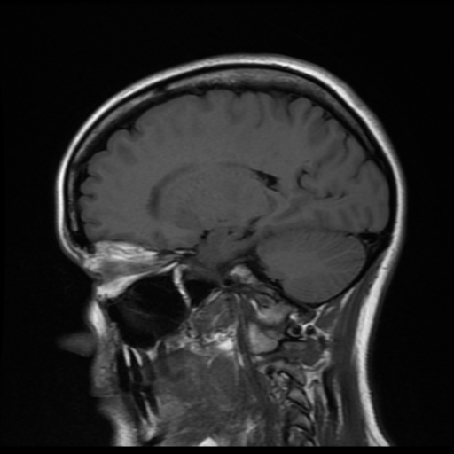 File:Cerebral autosomal dominant arteriopathy with subcortical infarcts and leukoencephalopathy (CADASIL) (Radiopaedia 41018-43768 Sagittal T1 13).png