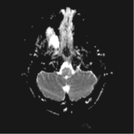 File:Cerebral cavernoma and development venous anomaly (Radiopaedia 37603-39482 Axial ADC 4).png