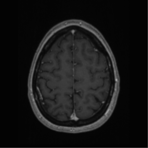 Cerebral cavernoma and development venous anomaly (Radiopaedia 37603-39482 Axial T1 C+ 61).png