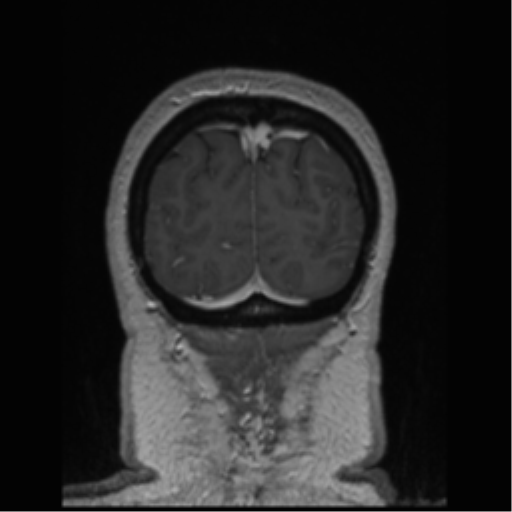Cerebral cavernoma and development venous anomaly (Radiopaedia 37603-39482 Coronal T1 C+ 12).png