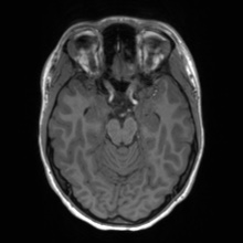 Cerebral cavernous venous malformation (Radiopaedia 70008-80021 Axial T1 26).jpg