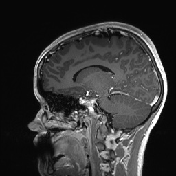 Cerebral cavernous venous malformation (Radiopaedia 70008-80021 Sagittal T1 C+ 42).jpg