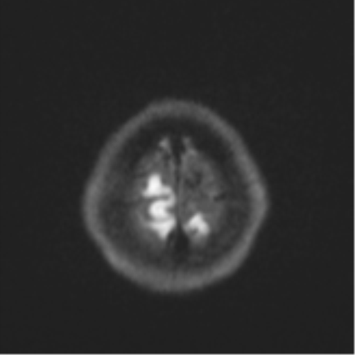 Cerebral cavernous venous malformations (Radiopaedia 48117-52946 Axial DWI 54).png