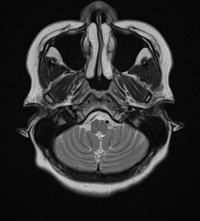 File:Cerebral cavernous venous malformations (Radiopaedia 48117-52946 Axial T2 3).png