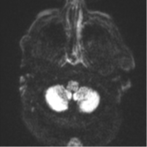 Cerebral embolic infarcts (embolic shower) (Radiopaedia 57395-64342 Axial DWI 41).png