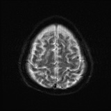 Cerebral embolic infarcts (embolic shower) (Radiopaedia 72391-82921 Axial DWI 25).jpg