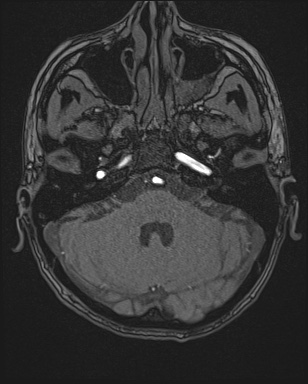 Cerebral embolic infarcts (embolic shower) (Radiopaedia 72391-82921 Axial MRA 21).jpg