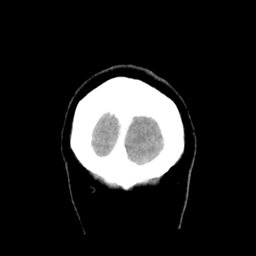 File:Cerebral hemorrhage secondary to arteriovenous malformation (Radiopaedia 33497-34561 C 64).png