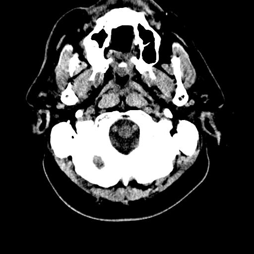 File:Cerebral hemorrhagic contusions and cervical spine fractures (Radiopaedia 32865-33841 Axial non-contrast 3).jpg