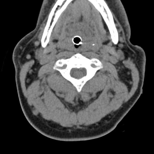 Cerebral hemorrhagic contusions and cervical spine fractures (Radiopaedia 32865-33841 F 19).jpg