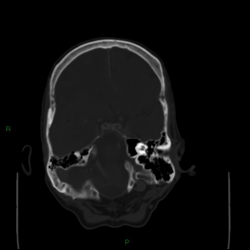 Cerebral metastases - breast primary (Radiopaedia 77653-89857 Axial bone window 35).jpg
