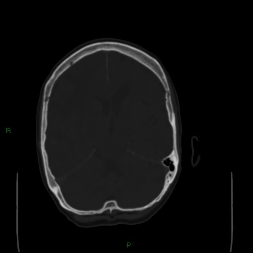 File:Cerebral metastases - breast primary (Radiopaedia 77653-89857 Axial bone window 53).jpg