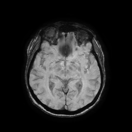 Cerebral metastases - melanoma (Radiopaedia 80972-94522 Axial SWI 47).jpg