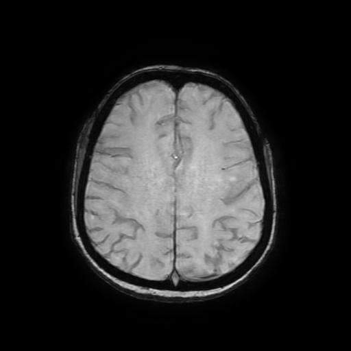Cerebral metastases - melanoma (Radiopaedia 80972-94522 Axial SWI 69).jpg