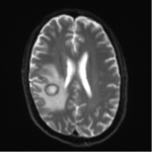 Cerebral metastasis - melanoma (Radiopaedia 54718-60954 Axial DWI 19).png