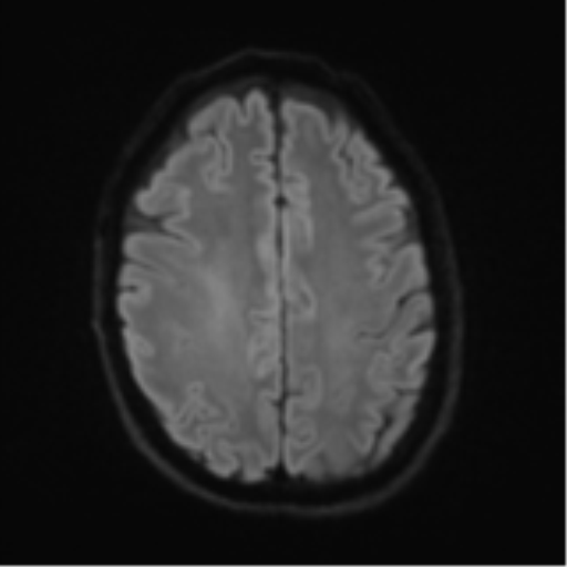 Cerebral metastasis - melanoma (Radiopaedia 54718-60954 Axial DWI 52).png