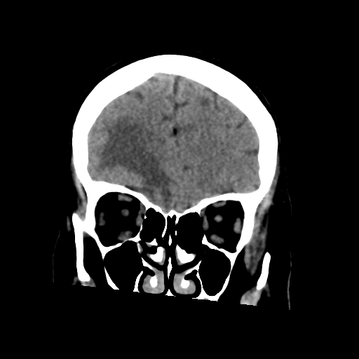 Cerebral metastasis to basal ganglia (Radiopaedia 81568-95412 Coronal non-contrast 20).png