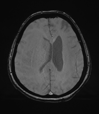 Cerebral metastasis to basal ganglia (Radiopaedia 81568-95413 Axial SWI magnitude 57).png