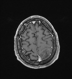 File:Cerebral toxoplasmosis (Radiopaedia 43956-47461 Axial T1 C+ 66).jpg