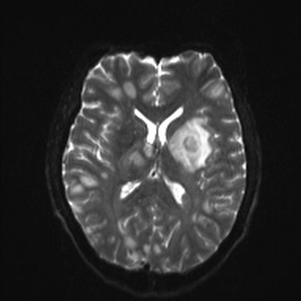 Cerebral toxoplasmosis (Radiopaedia 53993-60132 Axial DWI 15).jpg