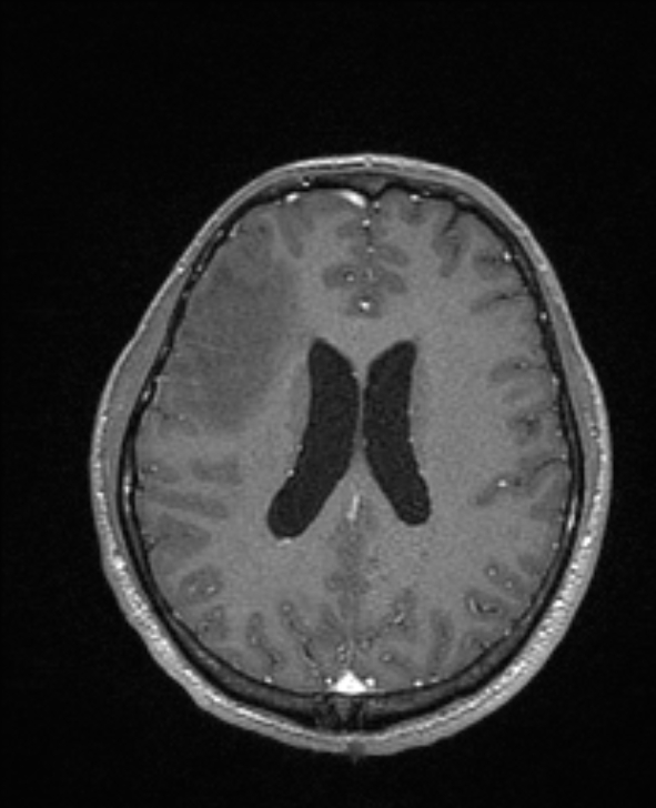Cerebral toxoplasmosis (Radiopaedia 85779-101597 Axial T1 C+ 103).jpg
