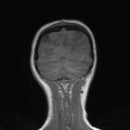 Cerebral tuberculosis with dural sinus invasion (Radiopaedia 60353-68090 Coronal T1 152).jpg