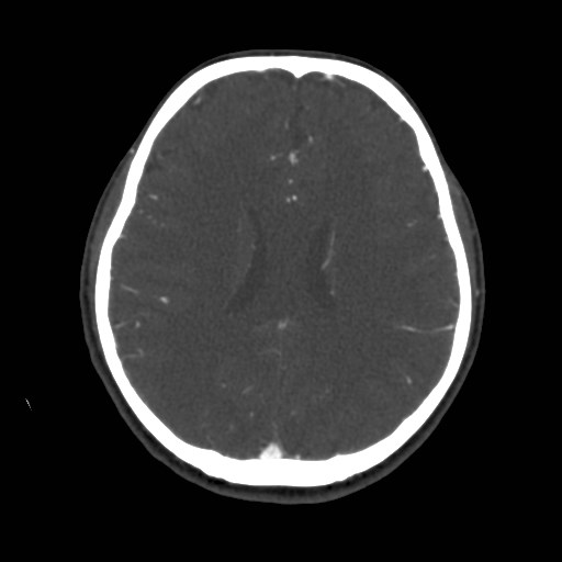 Cerebral venous sinus thrombosis (Radiopaedia 40619-43227 A 143).jpg