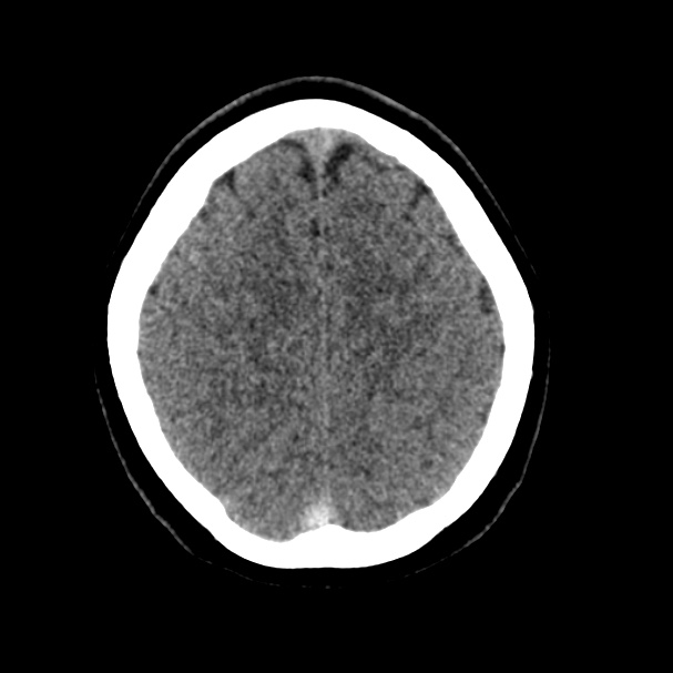 Cerebral venous sinus thrombosis (Radiopaedia 59224-66551 Axial non-contrast 37).jpg