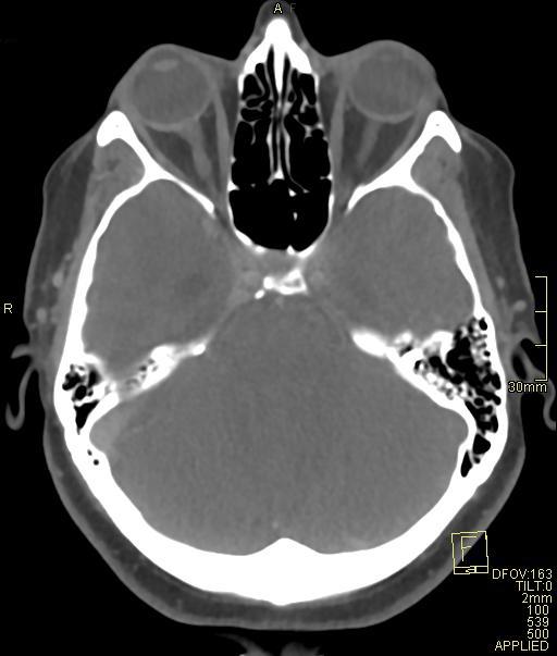 Cerebral venous sinus thrombosis (Radiopaedia 91329-108965 Axial venogram 27).jpg