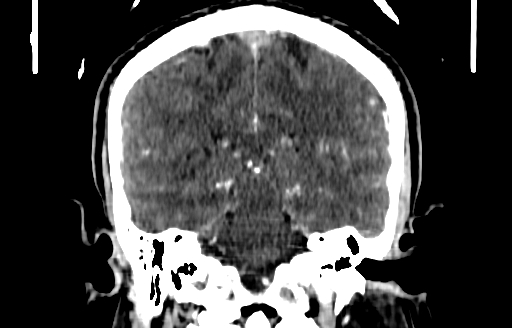 Cerebral venous thrombosis (CVT) (Radiopaedia 77524-89685 C 39).jpg