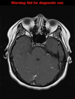 File:Cerebral venous thrombosis (Radiopaedia 37224-39208 Axial T1 C+ 7).jpg