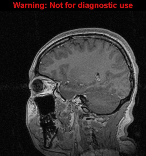 Cerebral venous thrombosis (Radiopaedia 37224-39208 Sagittal T1 C+ 102).jpg