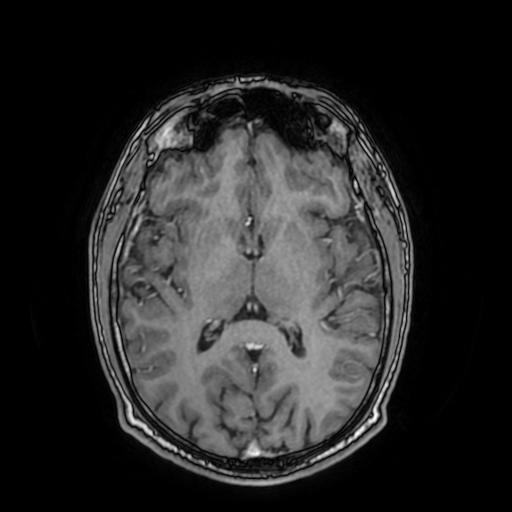 File:Cerebral venous thrombosis with secondary intracranial hypertension (Radiopaedia 89842-106957 Axial T1 C+ 99).jpg