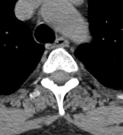 Cervical canal stenosis - OPLL and osteophytes (Radiopaedia 47329-51910 Axial non-contrast 70).png