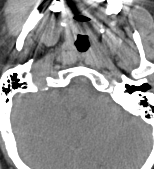 Cervical canal stenosis due to ossification of the posterior longitudinal ligament (Radiopaedia 47260-51823 Axial non-contrast 4).png