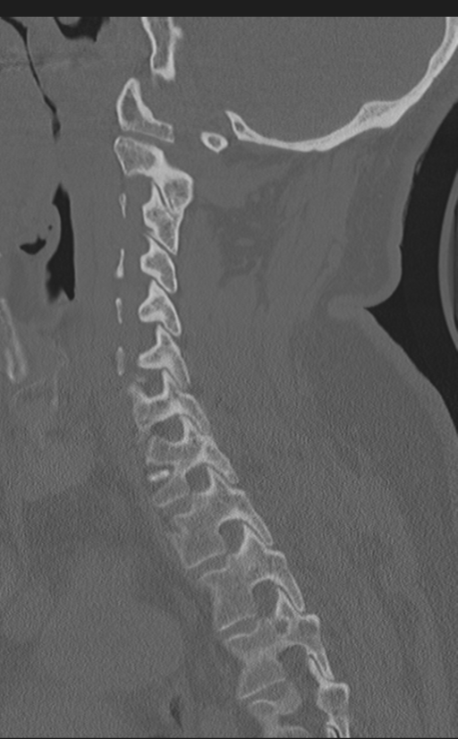 Cervical canal stenosis due to ossification of the posterior longitudinal ligament (Radiopaedia 47260-51823 Sagittal bone window 28).png