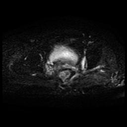 File:Cervical carcinoma (Radiopaedia 70924-81132 Axial DWI 10).jpg