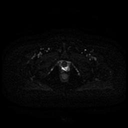 Cervical carcinoma (Radiopaedia 85405-101028 Axial DWI 2).jpg
